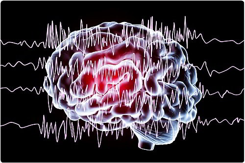 Эпилепсия: причины, симптомы, диагностика, лечение